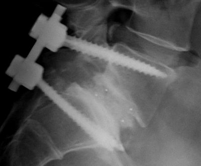 Spinal Fusion