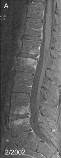 Spondylitis
