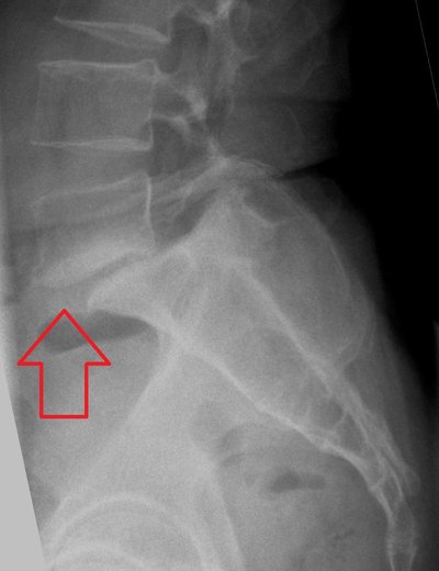 Spondylolisthesis