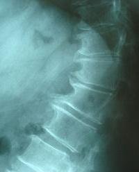 Spondylosis