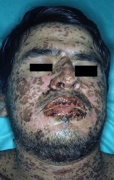 Stevens–Johnson syndrome