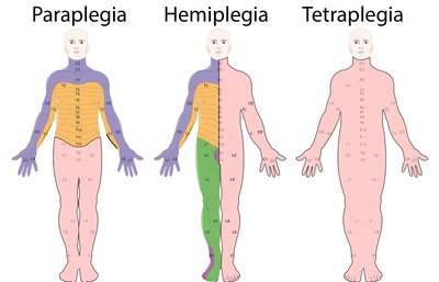 Tetraplegia