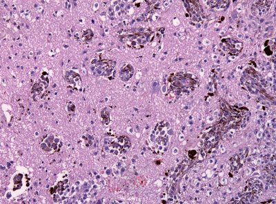 The Hallmarks Of Cancer