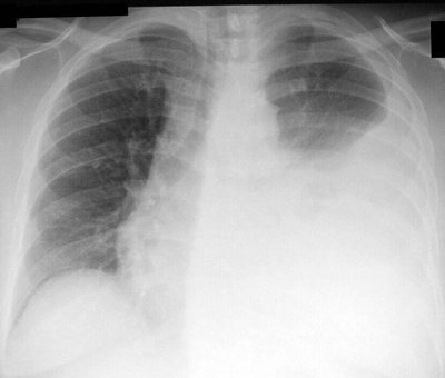 Thoracentesis