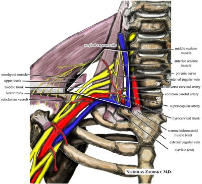 Thoracic Outlet Syndrome