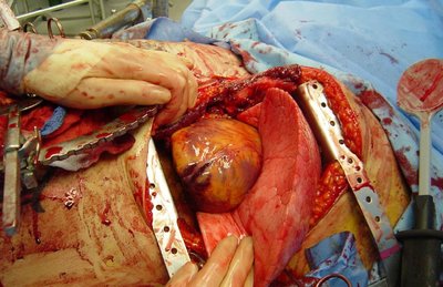 Thoracotomy