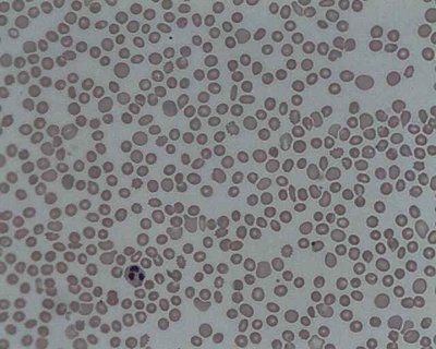 Thrombocytopenia