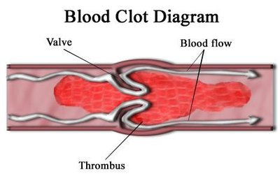 Thrombus
