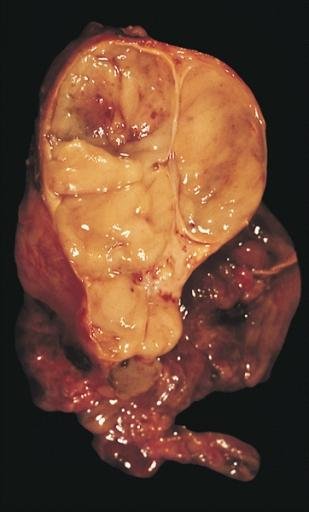 Thymoma