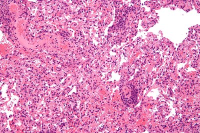 Transplant Rejection