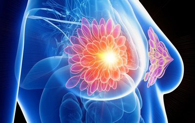 Triple-Negative Breast Cancer