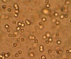 Urinary tract infection