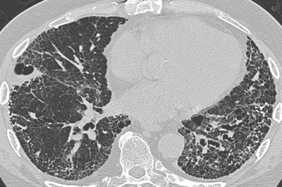 Usual Interstitial Pneumonia