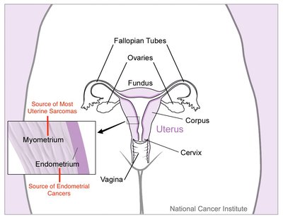 Uterine Cancer