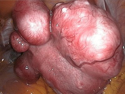 Uterine Fibroid