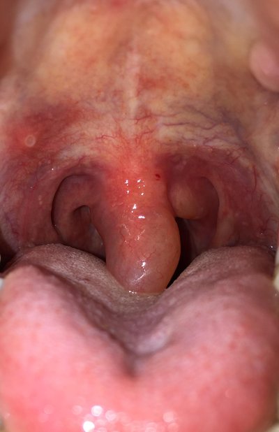 Uvula