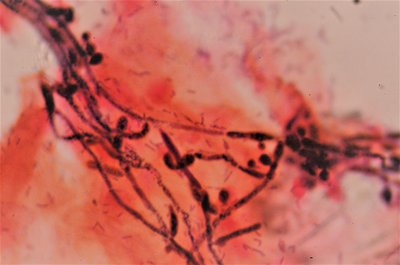 Vaginal Yeast Infection