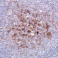 Variant Creutzfeldt–Jakob Disease