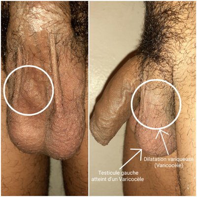 Varicocele