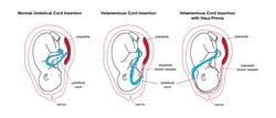 Velamentous Cord Insertion