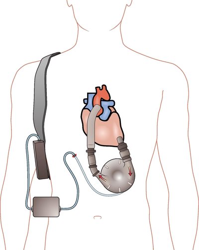 Ventricular Assist Device