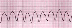 Ventricular Tachycardia