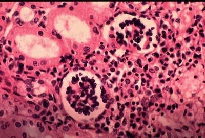 Visceral Leishmaniasis