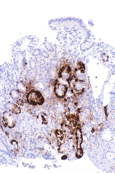 Vitamin B12 Deficiency Anemia